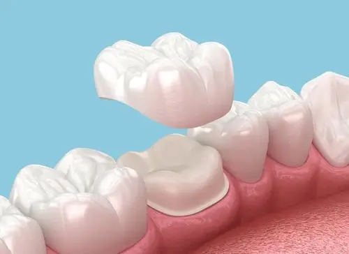 Close-up of a dental crown on a tooth model, highlighting its function and importance