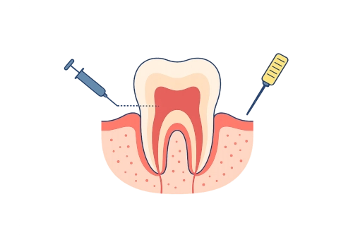 Dental crown placed after root canal to restore tooth strength